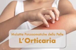 orticaria psicosomatica da stress